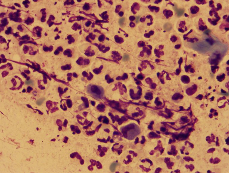 CNS-HIV Fungal culture U99